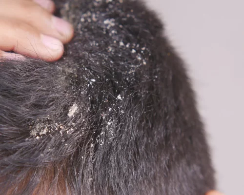 Dandruff