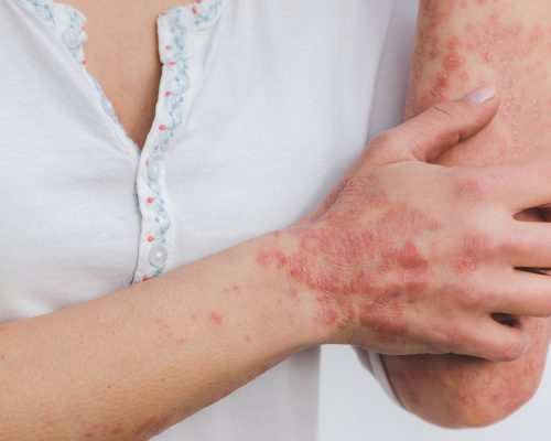 psoriasis-2